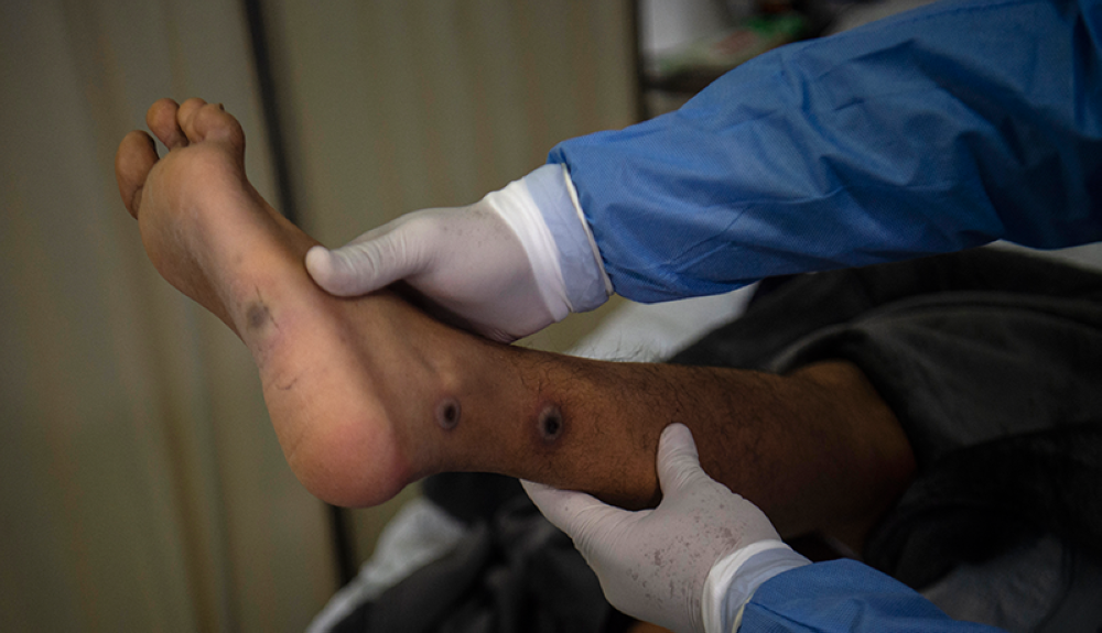 Un médico revisa a un paciente con llagas causadas por una infección de viruela del mono en Lima, Perú.AFP