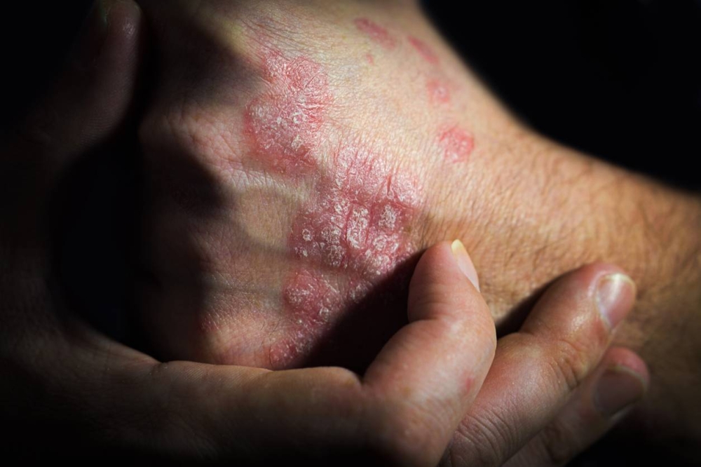 La psoriasis aún no tiene cura, pero con tratamiento médico se puede llevar. ,image_description:psoriasis is an autoimmune human disease. a man holds a hand at a psoriasis affected area of the skin